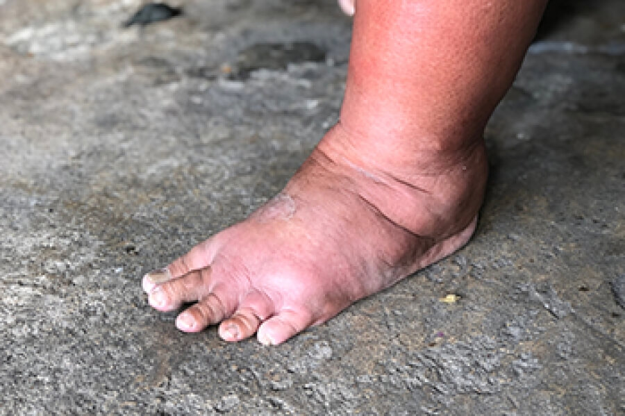 swollen-feet